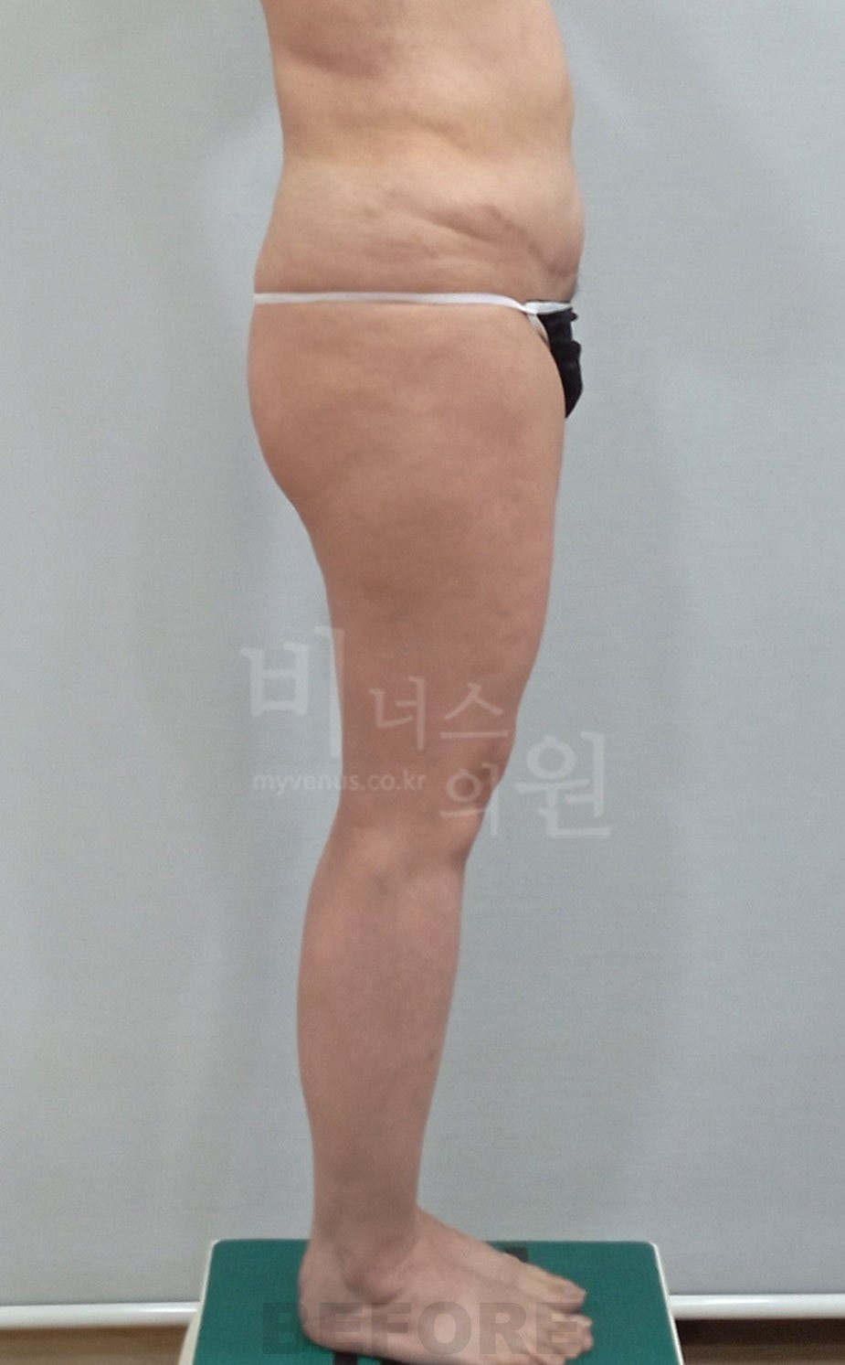 허벅지지방흡입 수술 전 측면 사진, 비너스의원