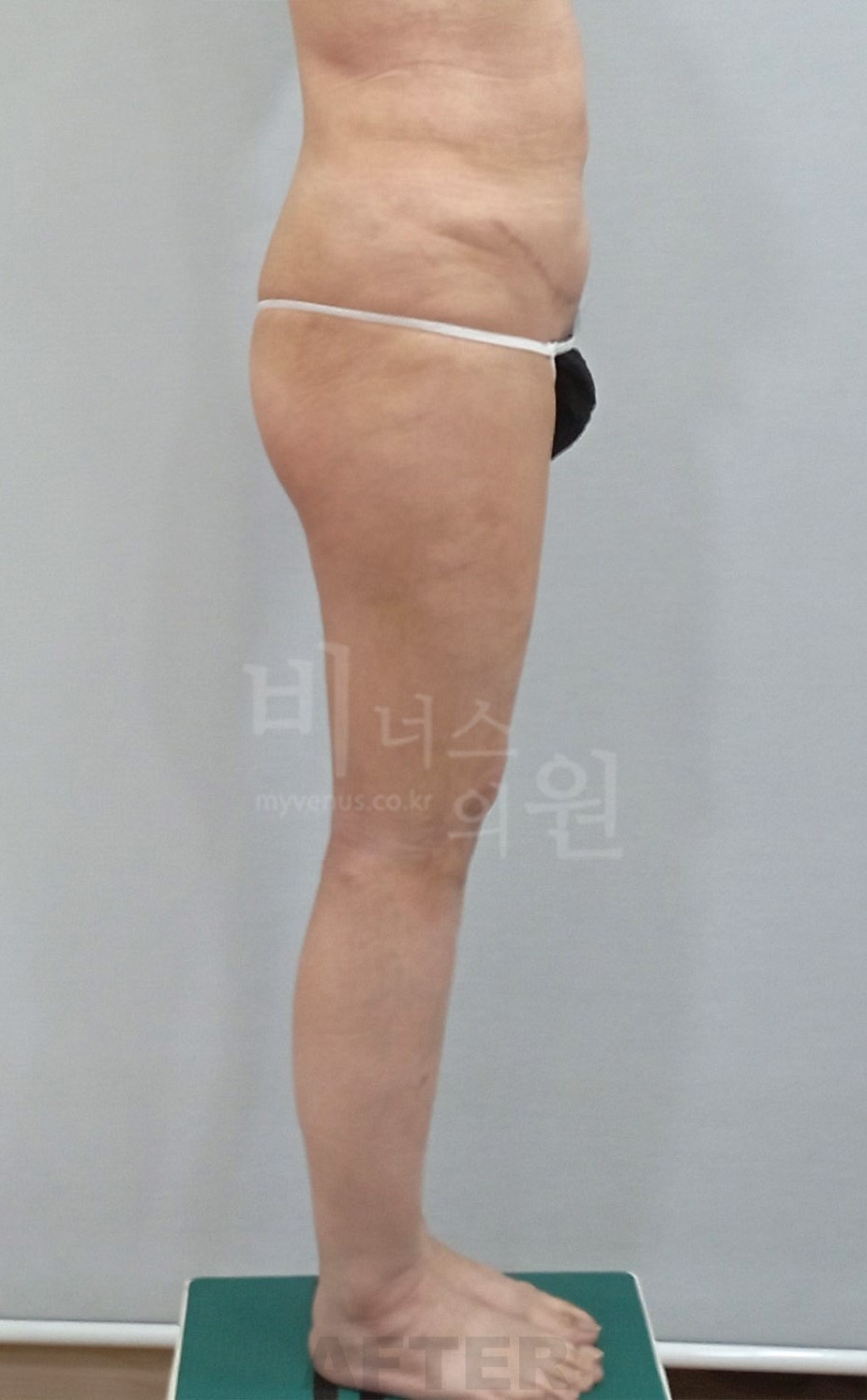 허벅지지방흡입 수술 후 측면 사진, 비너스의원