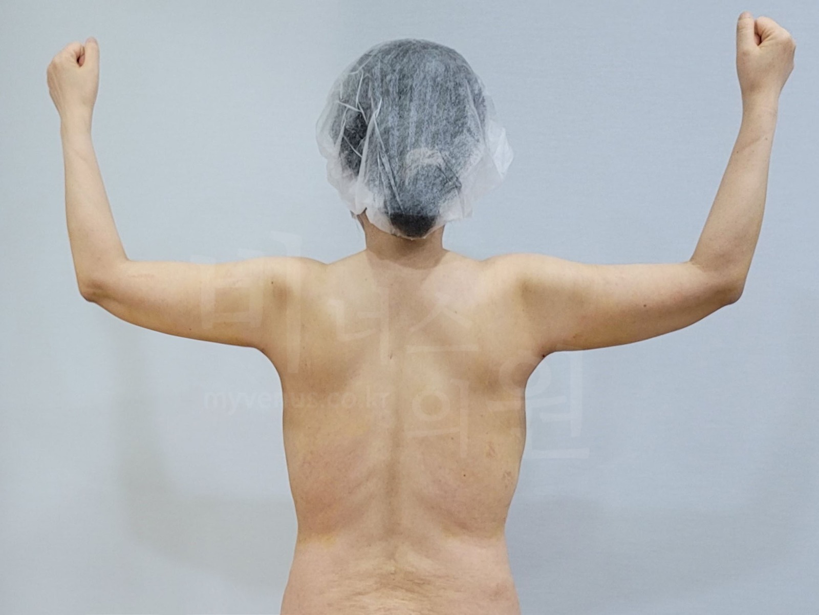 팔뚝 후면 사진 예시