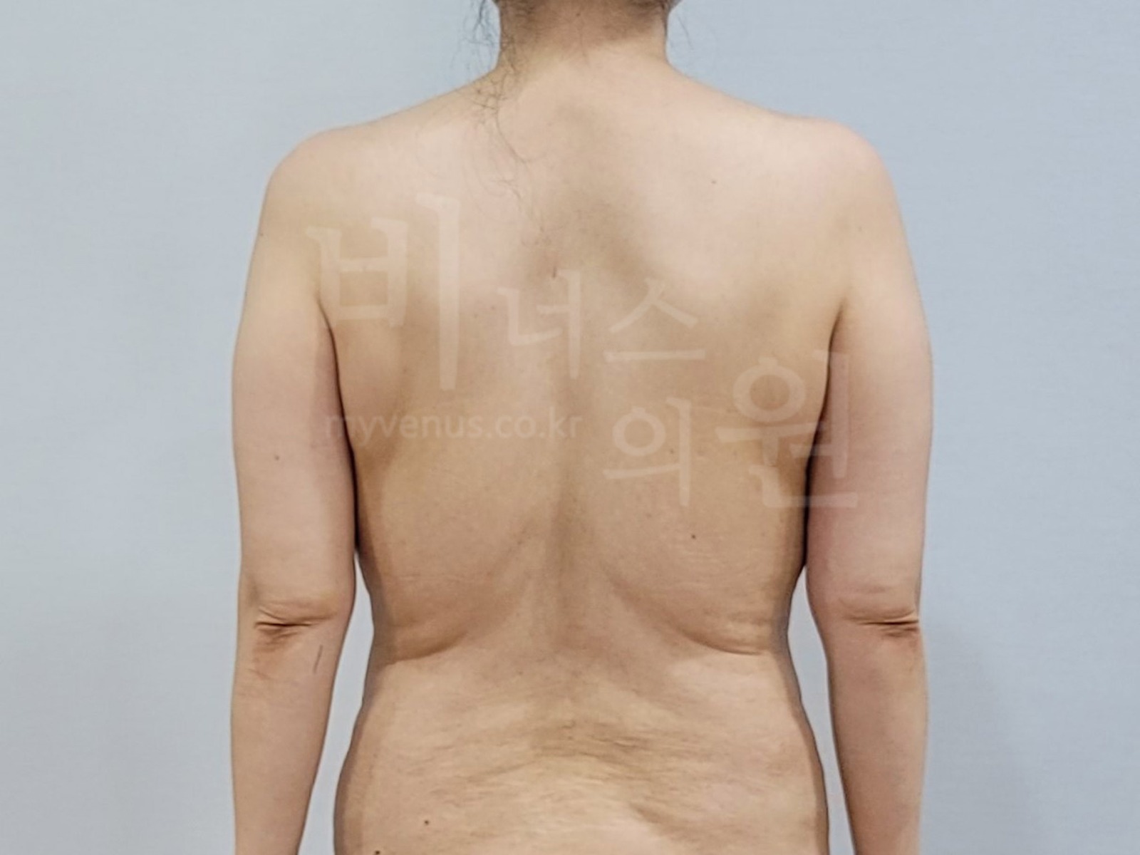팔뚝 후면 사진 예시