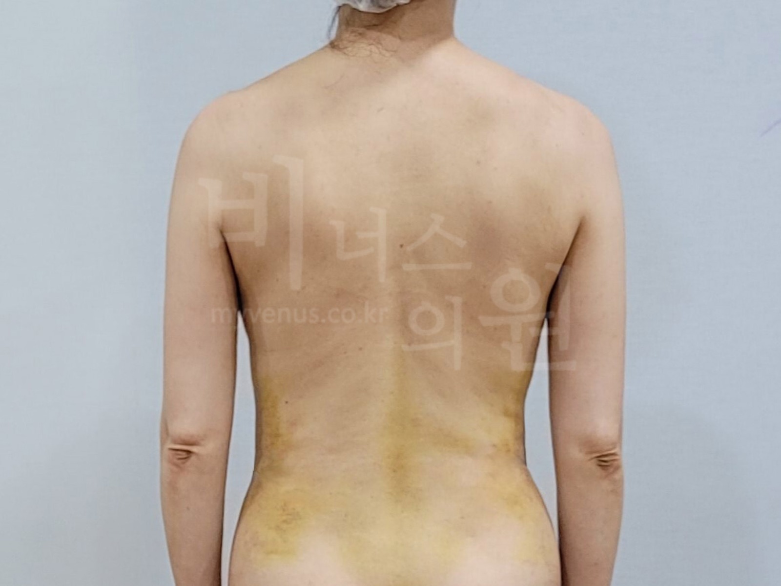 팔뚝 후면 사진 예시