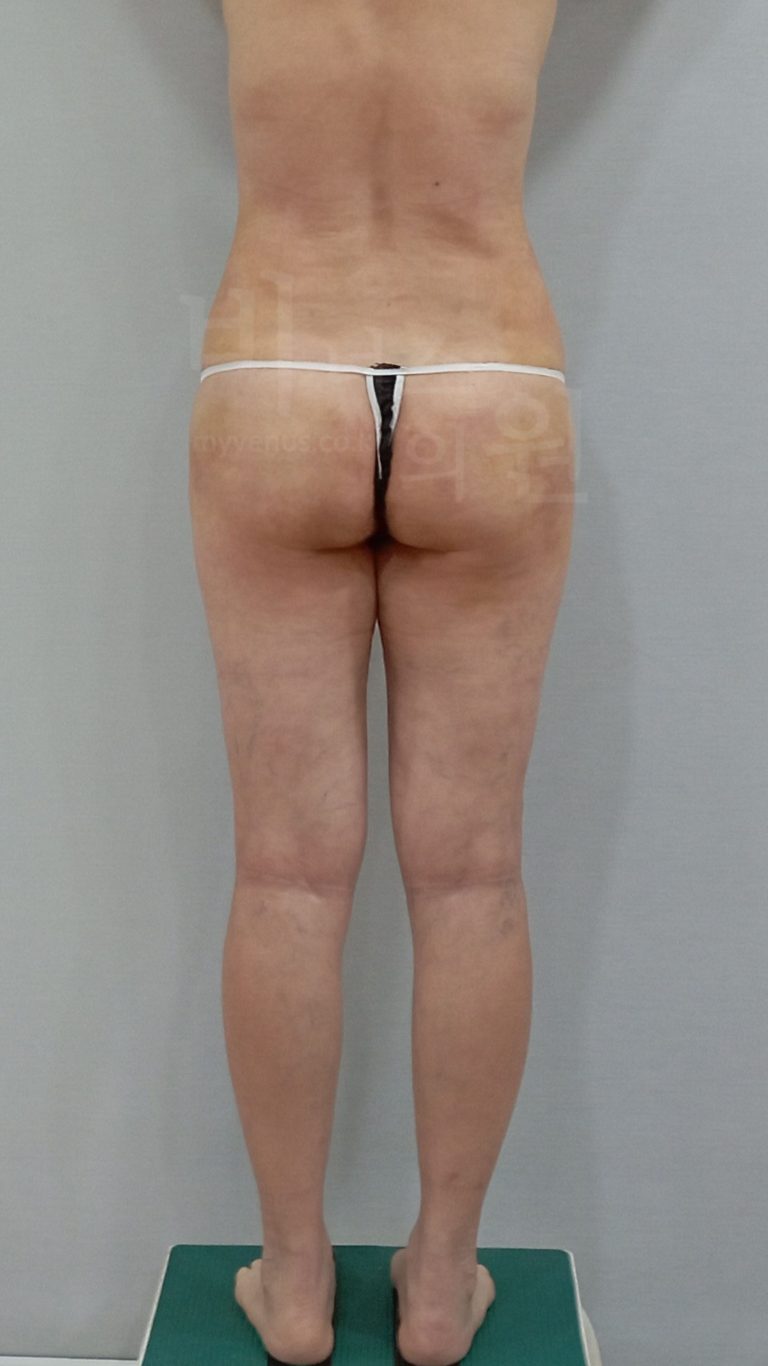 엉덩이축소 지방흡입 수술 후 후면 사진, 다리를 모은 자세, 비너스의원
