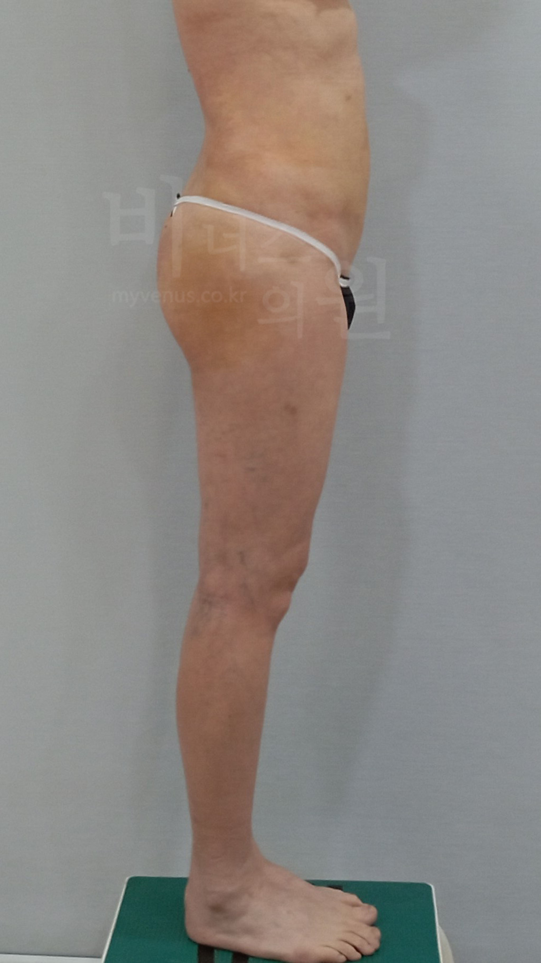 엉덩이축소 지방흡입 수술 후 측면 사진, 비너스의원