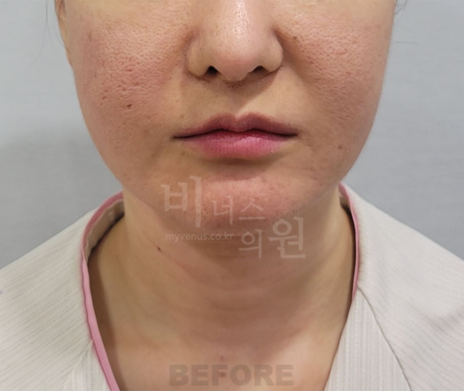 턱지방흡입 수술 전 정면