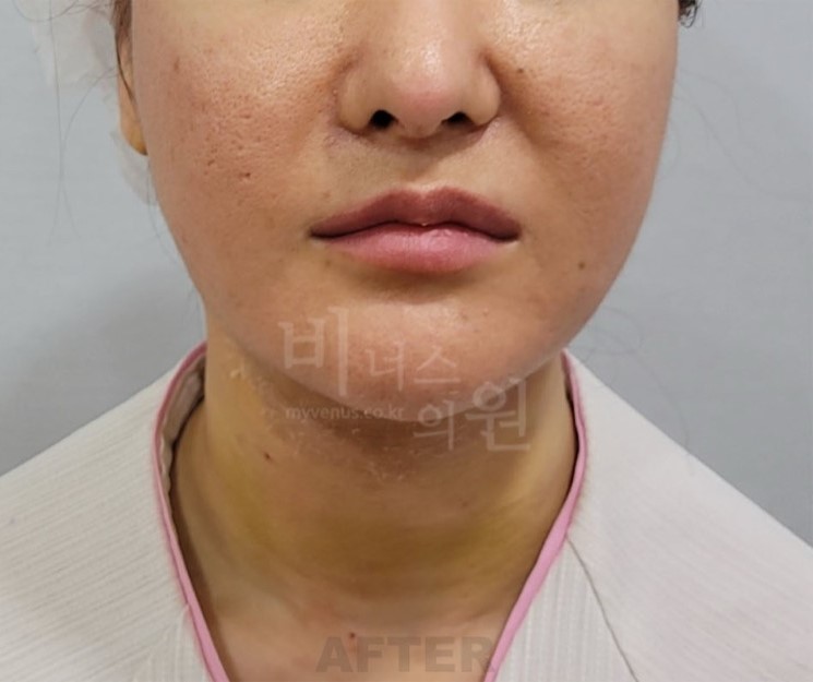 턱지방흡입 후 일상 관리 루틴 — 세안·수면·운동, 언제부터 다시 시작할 수 있을까