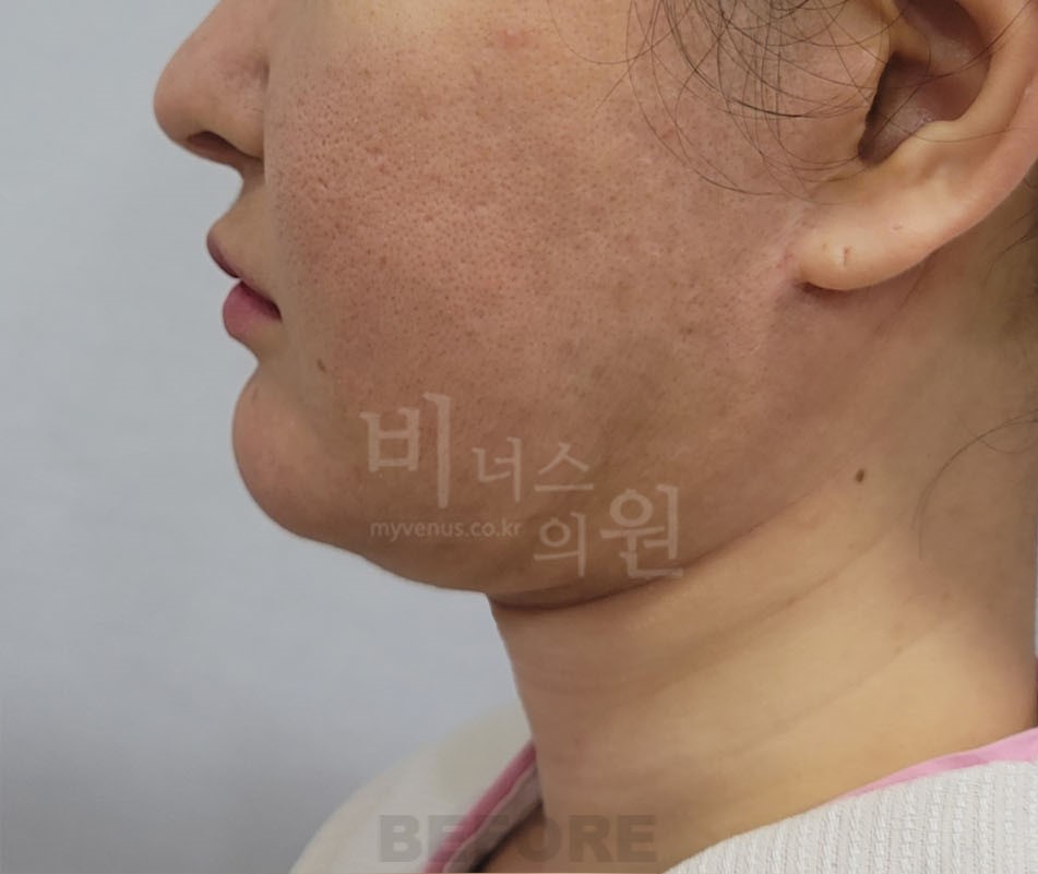 턱지방흡입 수술 전 측면