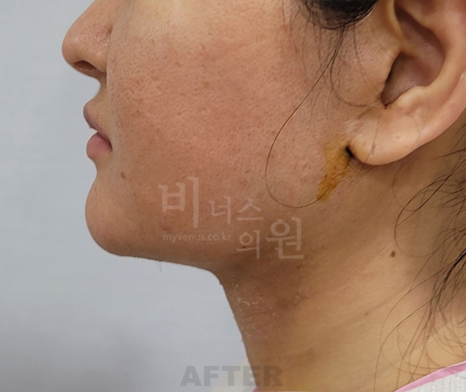 턱지방흡입 수술 후 측면