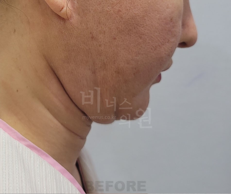 턱지방흡입 수술 전 반대측면