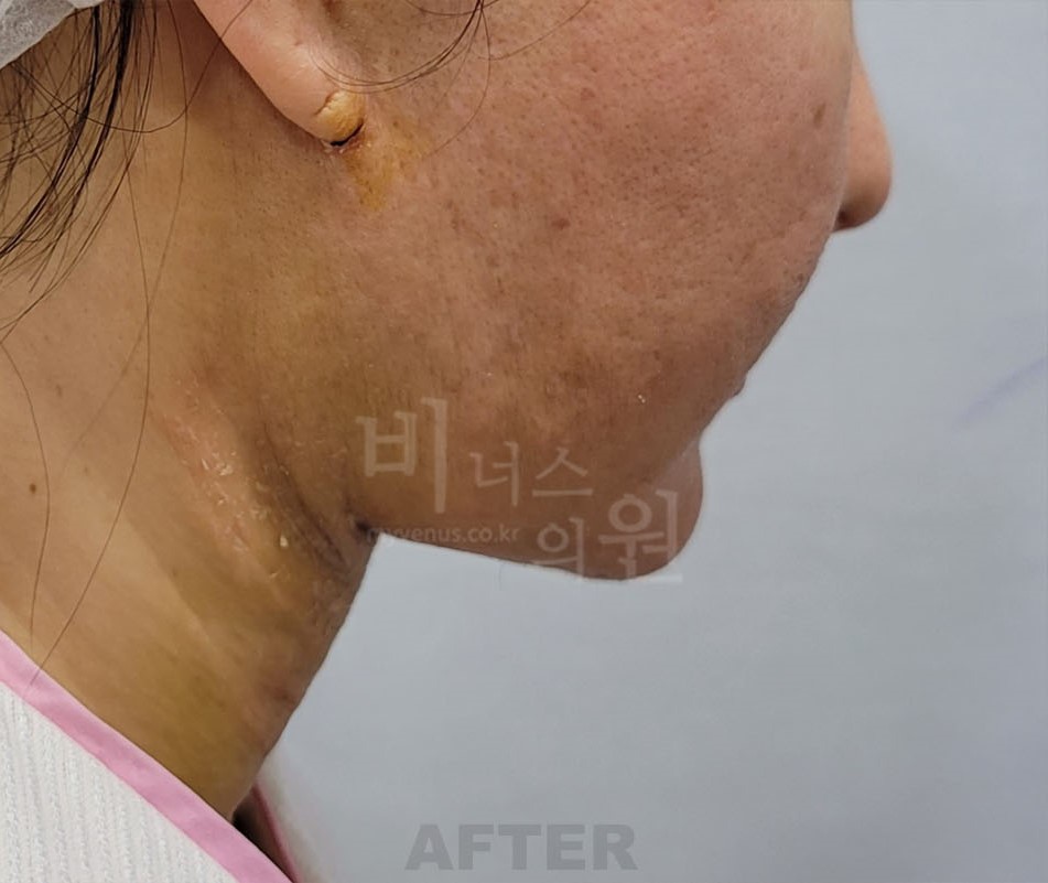 턱지방흡입 수술 후 반대측면