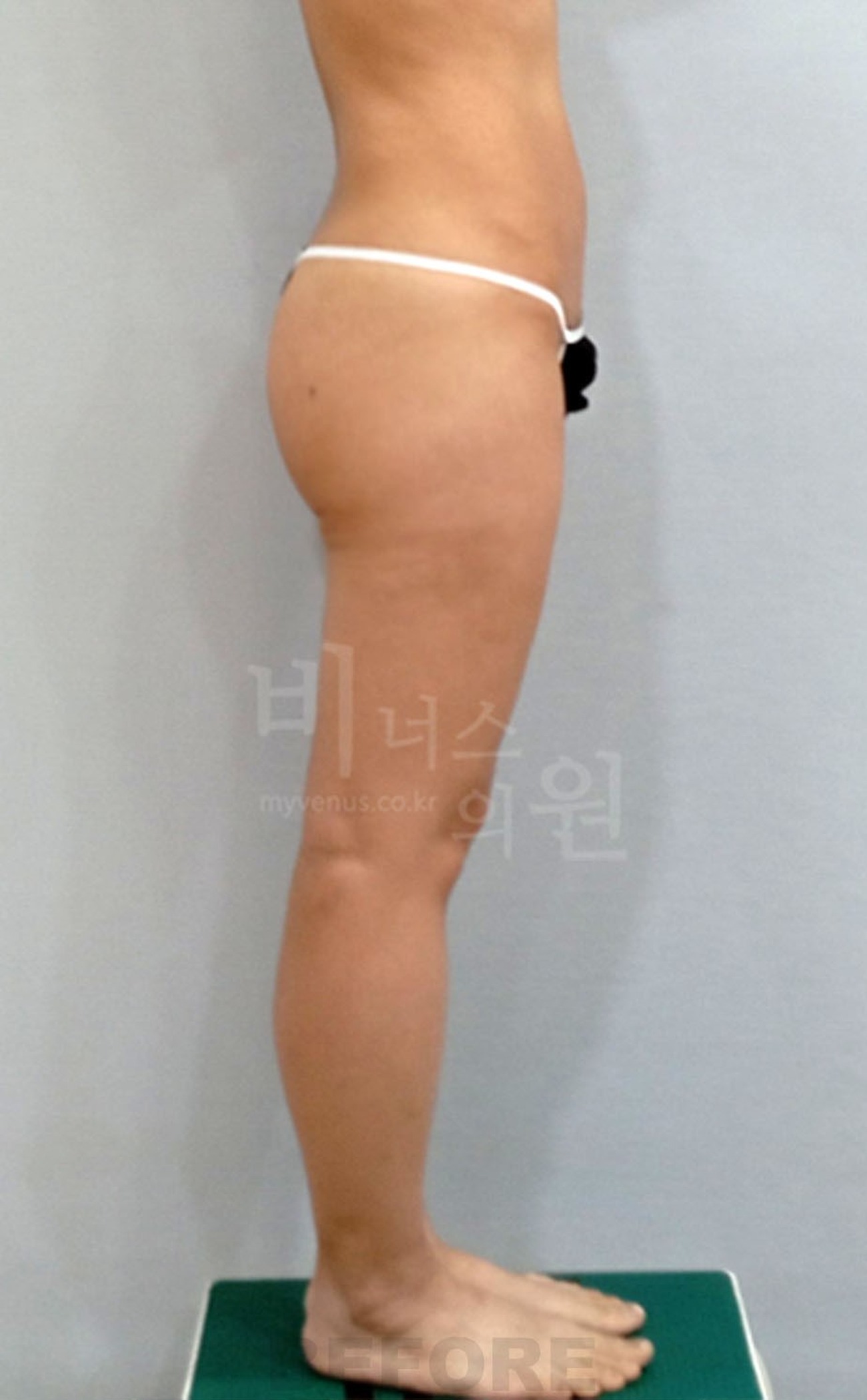 엉덩이 볼륨업 허벅지 안쪽 지방흡입 수술 전 측면 사진 2