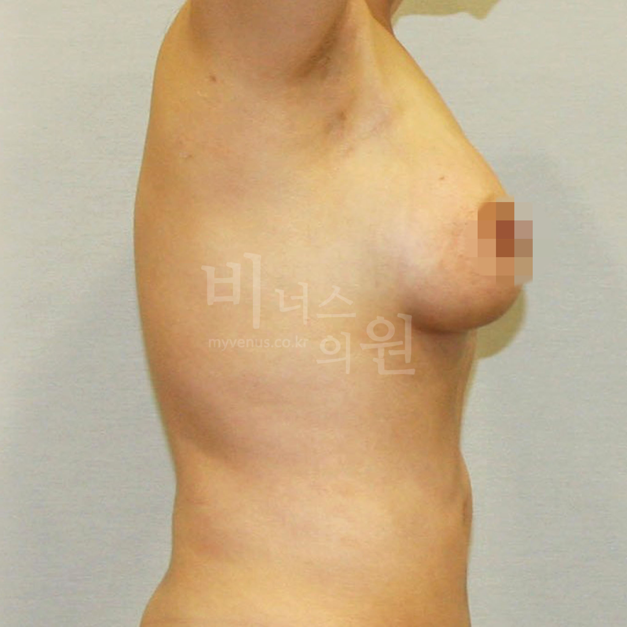 유방처짐 표층 지방흡입 수술 후 측면 사진