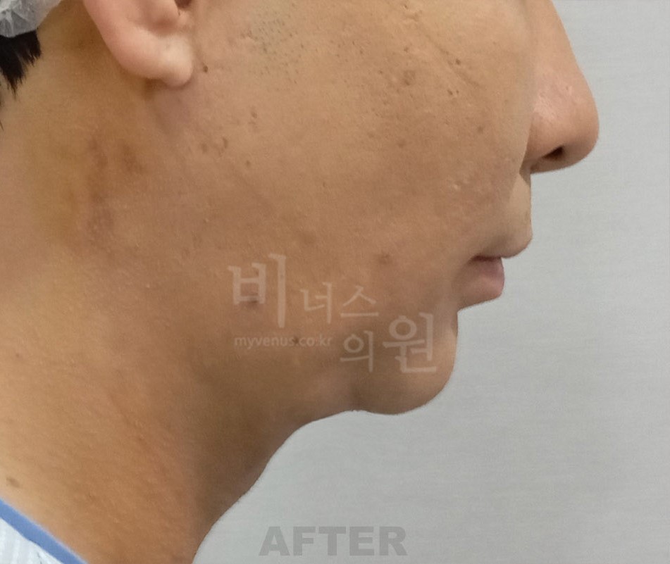 턱지방흡입 수술 후 좌측면