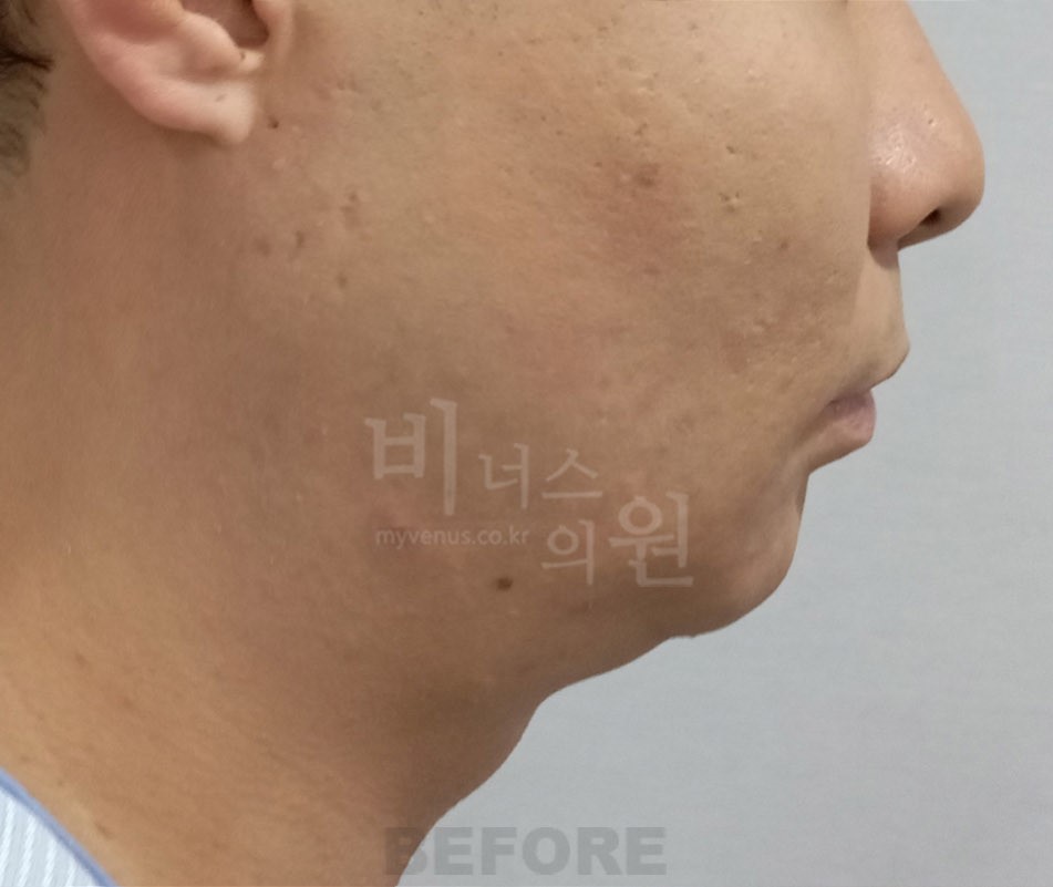 턱지방흡입 수술 전 좌측면