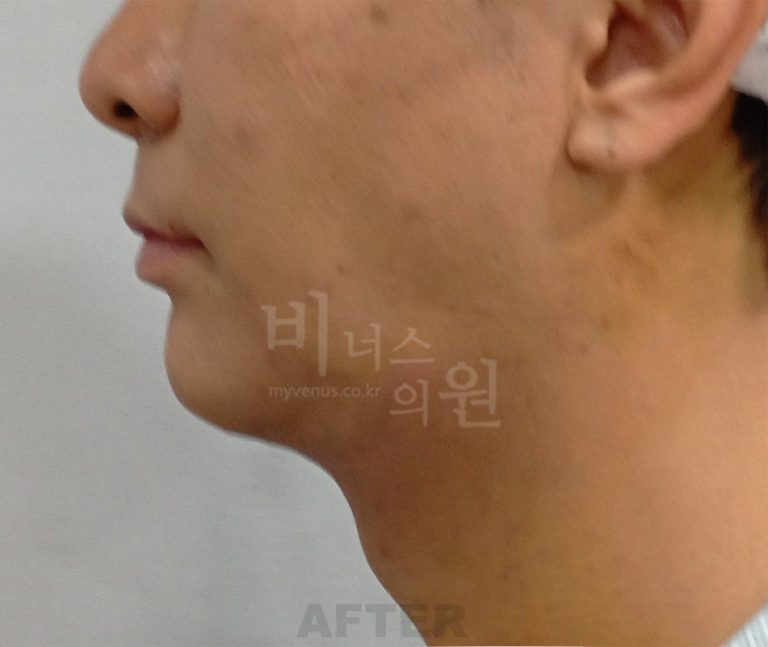 턱지방흡입 1주일 뒤 사진으로 보는 회복 초기 — 붓기가 남아 있는 시점, 어디까지 판단해도 될까요