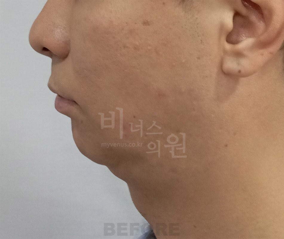 턱지방흡입 수술 전 45도 측면