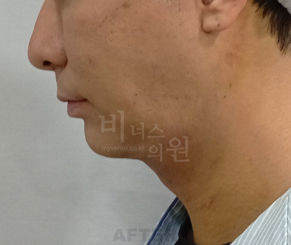 턱지방흡입 수술 후 우측면