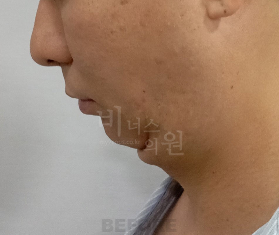 턱지방흡입 수술 전 우측면