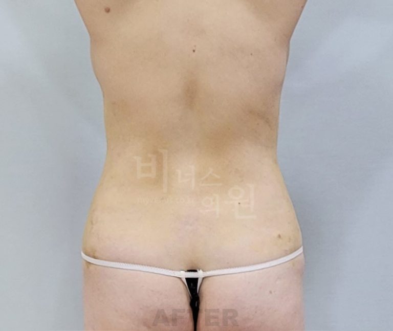 복부지방흡입 후 관리 루틴 — 압박복부터 체중 관리까지 챙겨야 할 것들