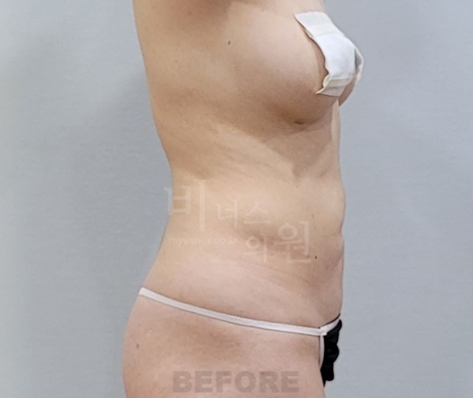 복부지방흡입 수술 전 우측면 사진