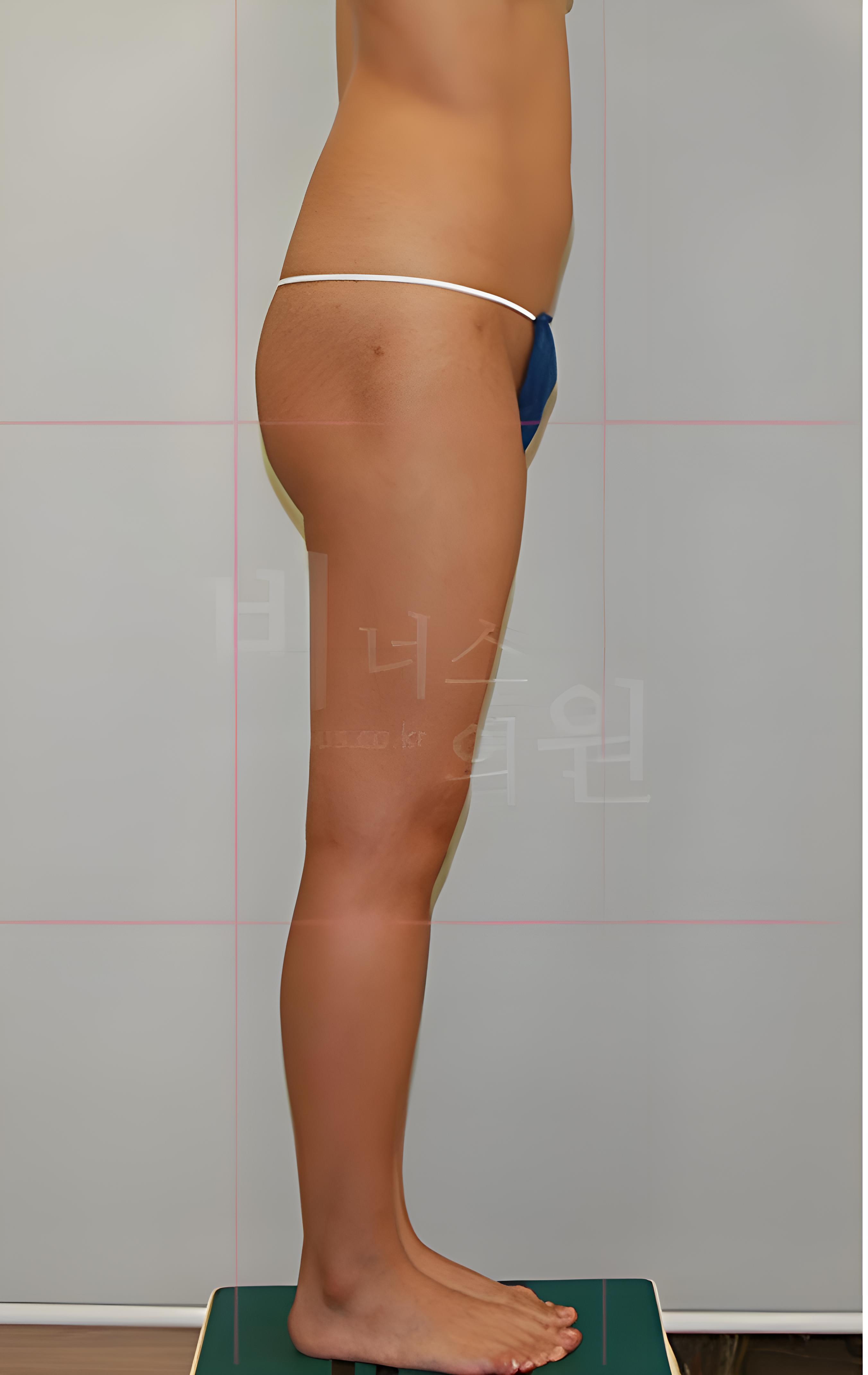 엉덩이축소 지방흡입 수술 전 반대측 측면 사진