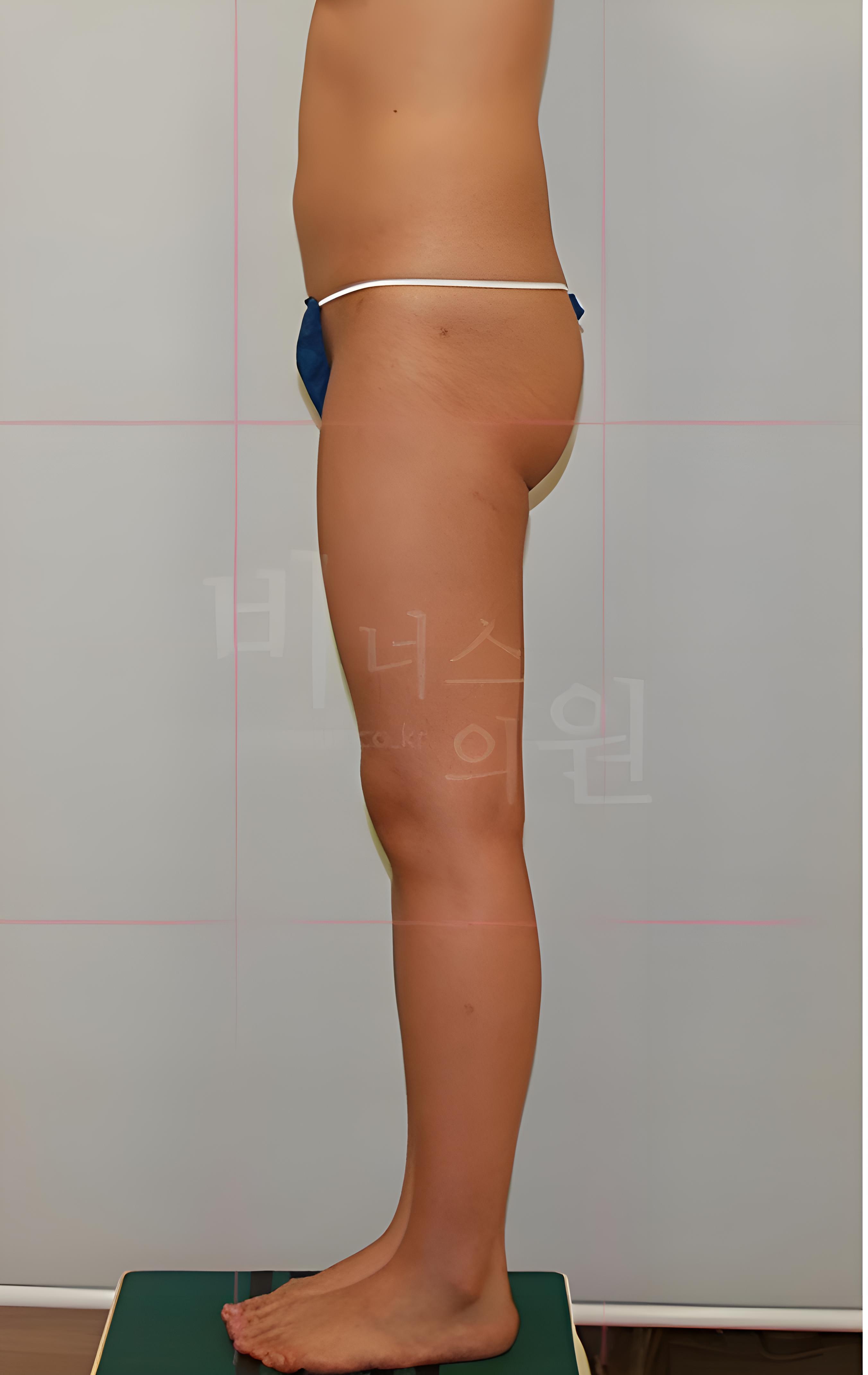 엉덩이축소 지방흡입 수술 전 측면 사진