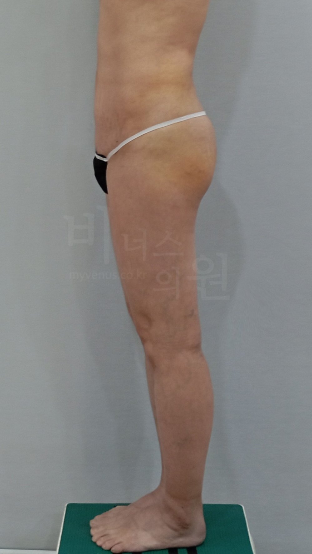 엉덩이축소 지방흡입 수술 후 우측면