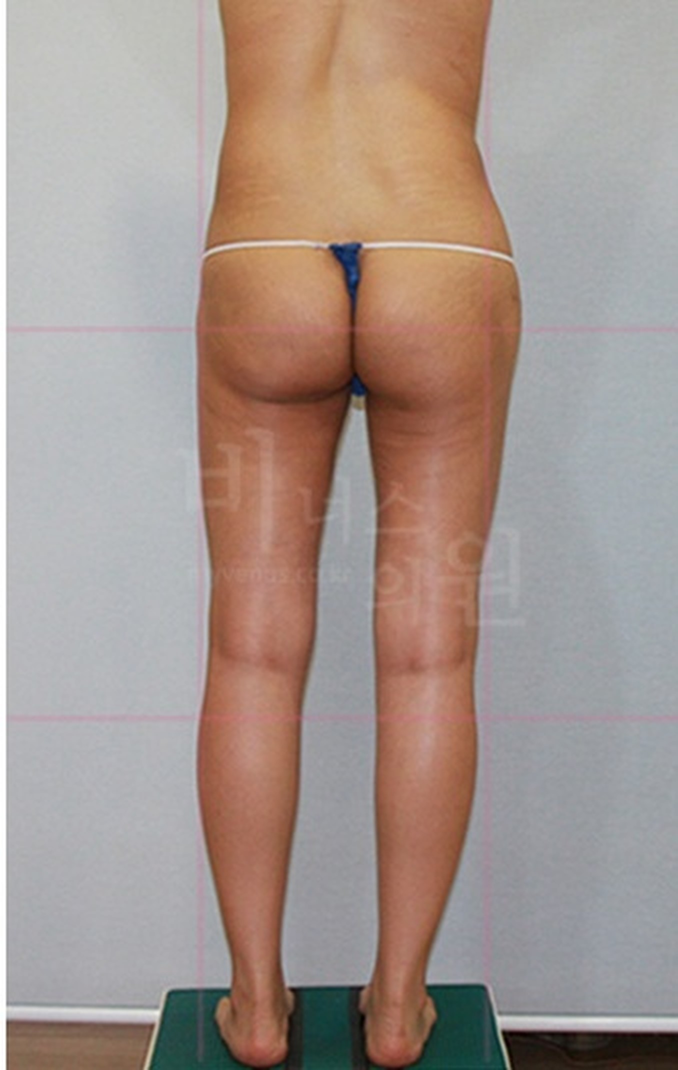 엉덩이축소 지방흡입 후면 수술 후