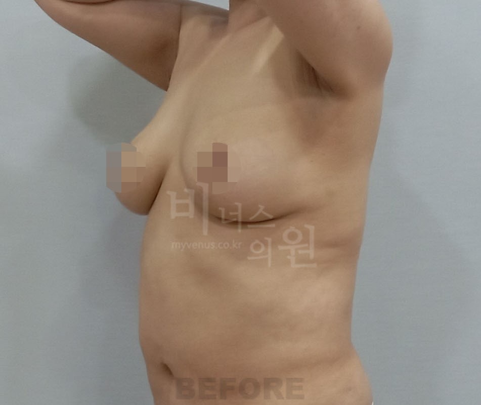 유방하수 지방흡입 수술 전 45도 측면 사진