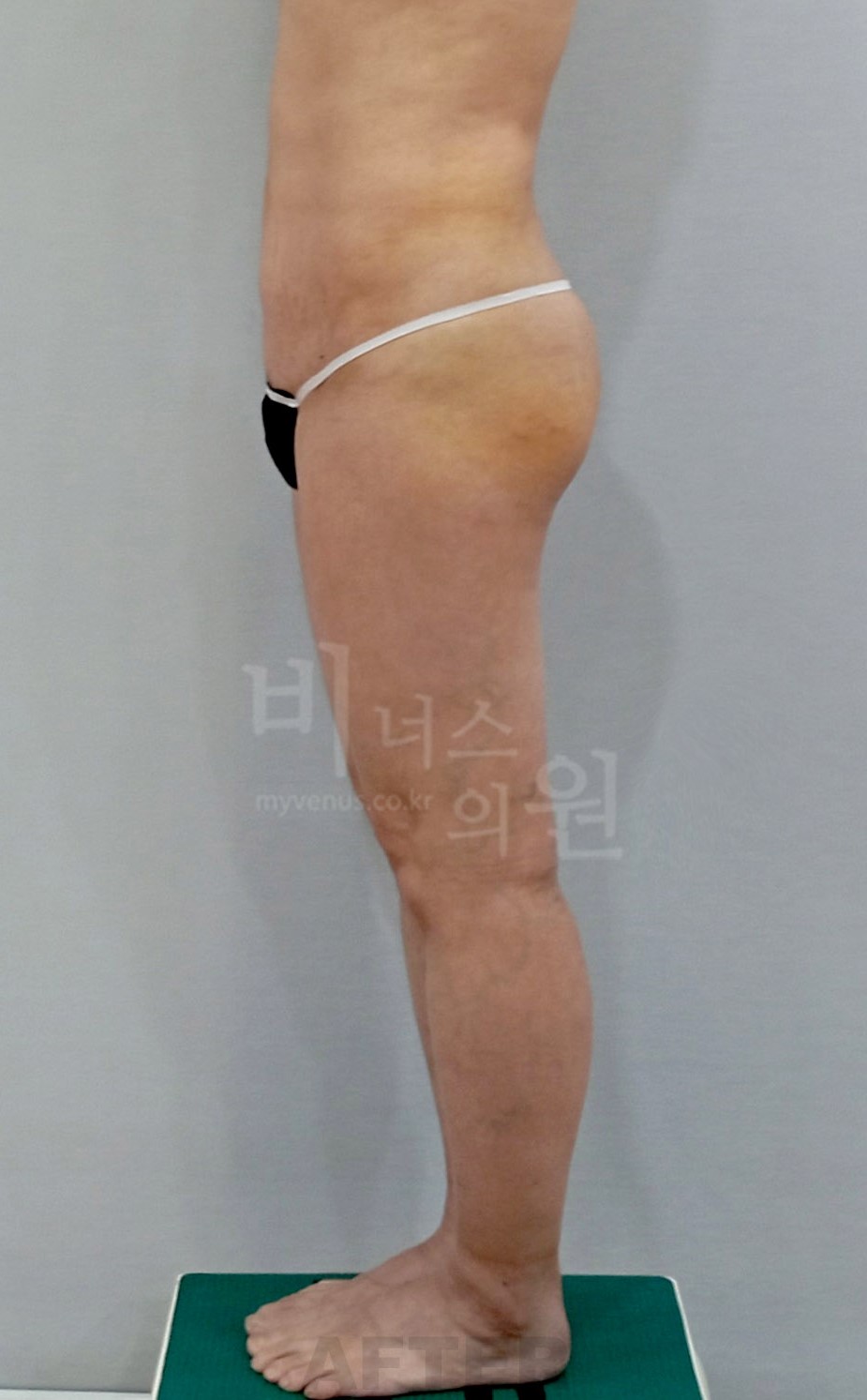 엉덩이 부위 수술 전후 비교 - 수술 후 (측면)