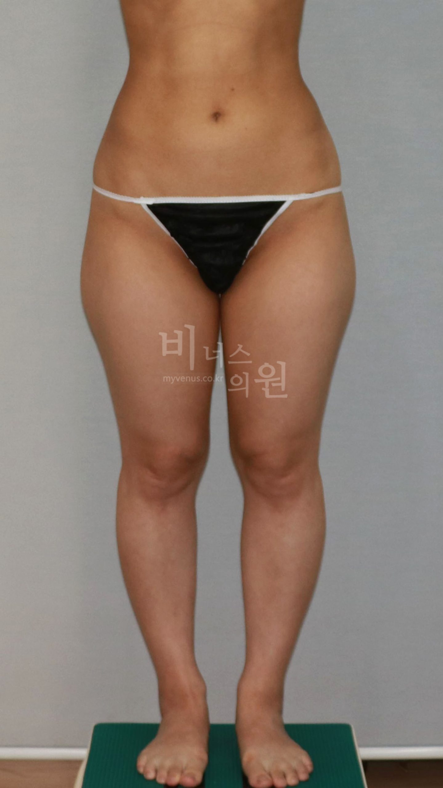 허벅지·엉덩이 지방흡입 수술 전 정면에서 본 하체 윤곽