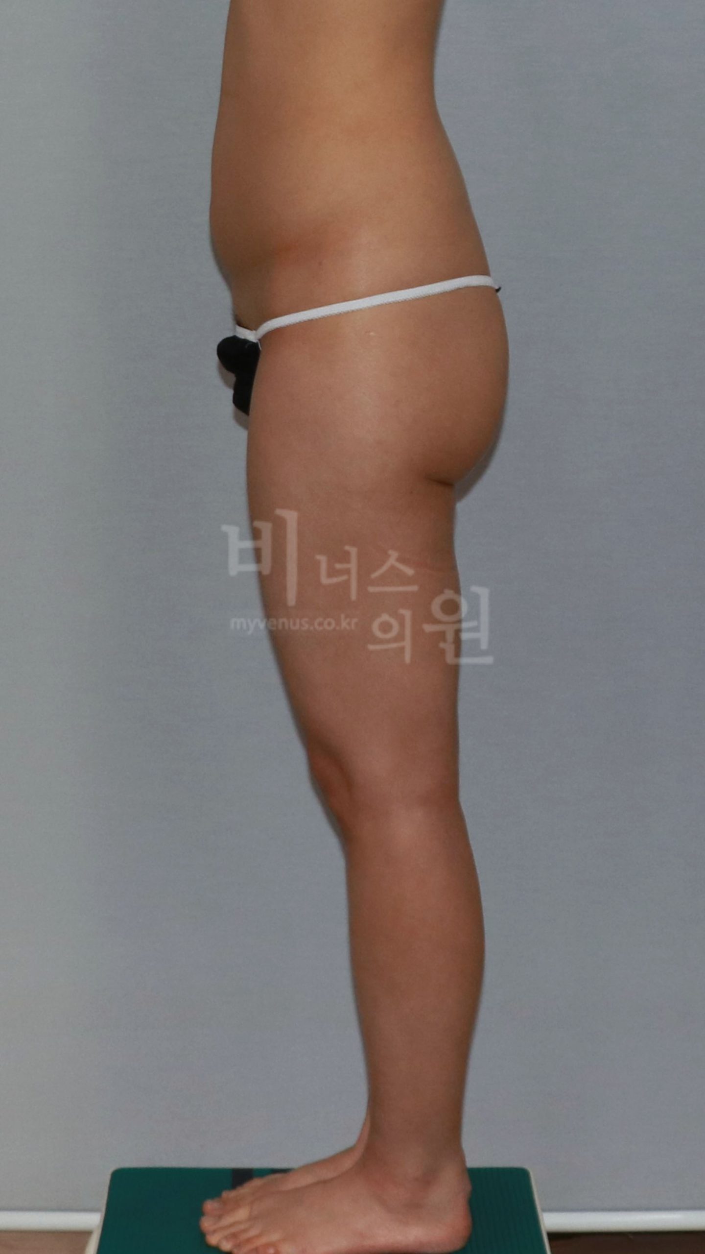 엉덩이축소 지방흡입 수술 전 측면 사진, 비너스의원