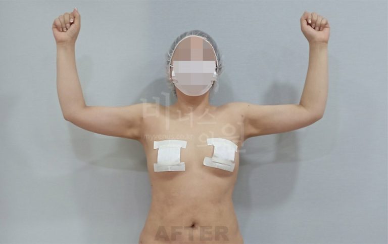 팔뚝 지방흡입, 상담 전 걱정과 실제 회복은 이렇게 달랐습니다