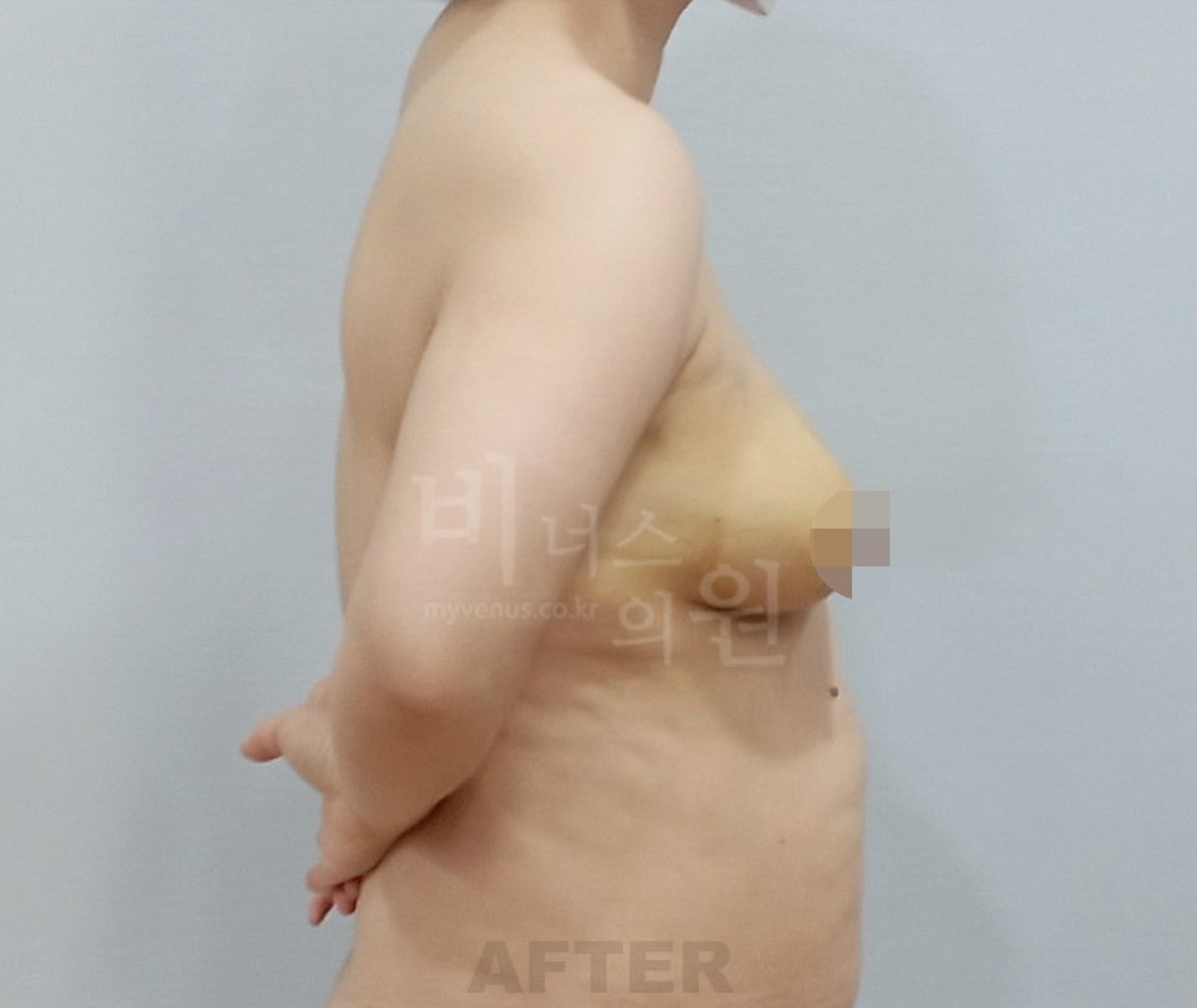 유방축소 지방흡입 수술 후 측면 사진