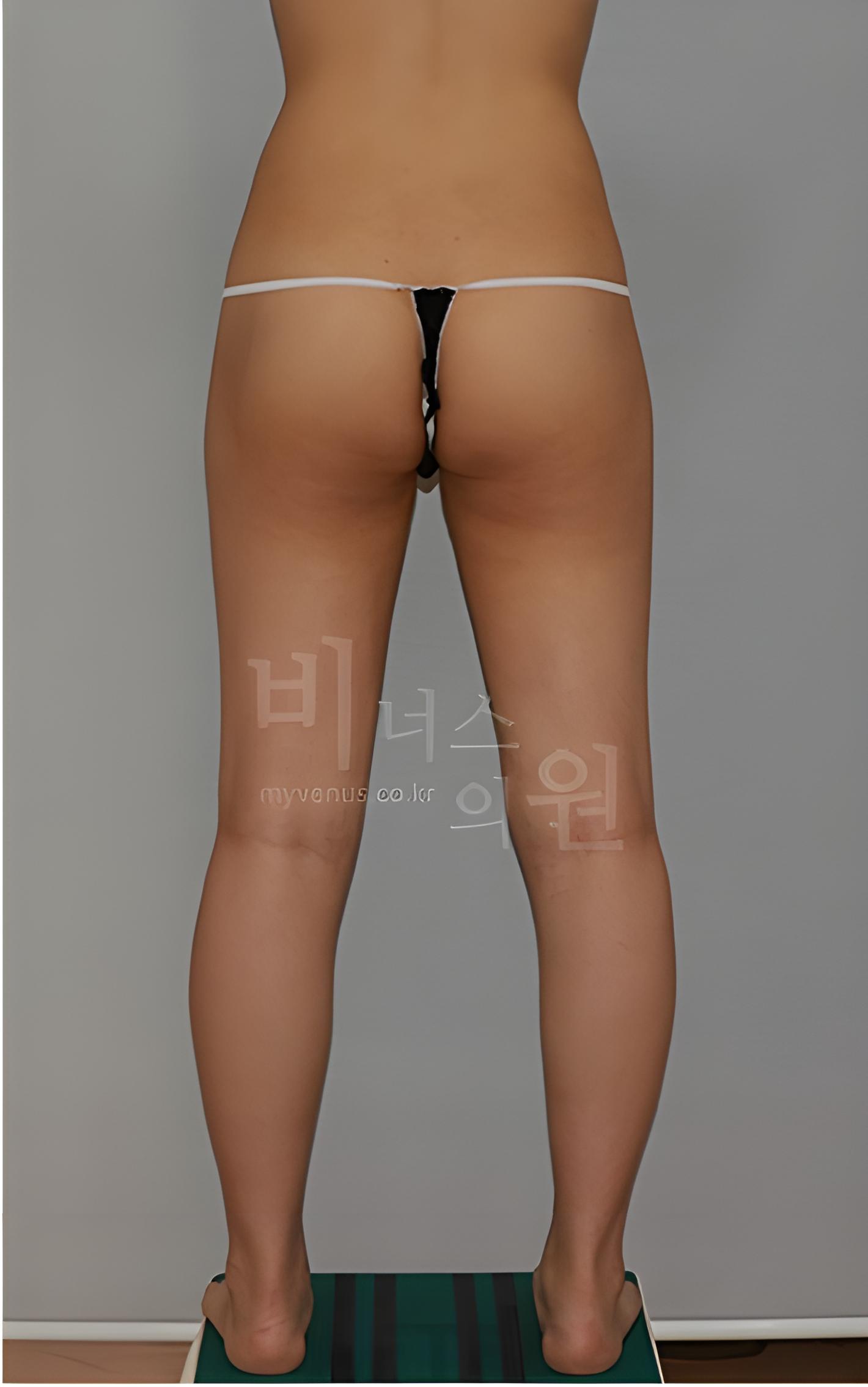 엉덩이축소 지방흡입 다른 사례 수술 후 정면 사진(2023년 촬영)