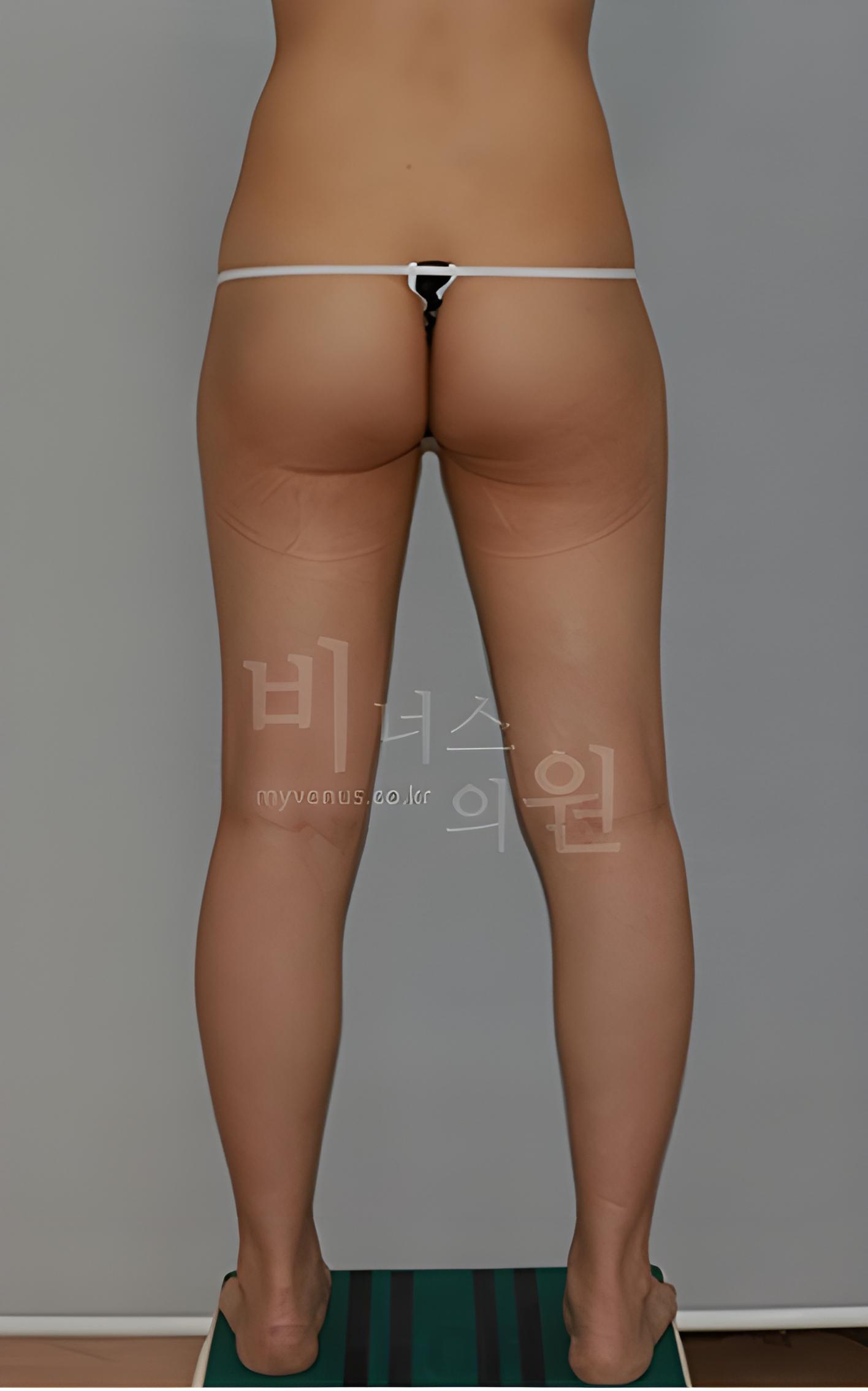 엉덩이축소 지방흡입 다른 사례 수술 전 정면 사진(2023년 촬영)