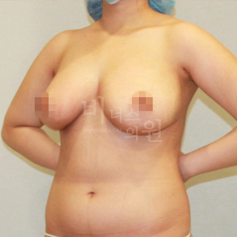 가슴이 무겁고 처져서 고민이라면 — 표층 지방흡입 하나로 사이즈와 처짐을 함께 보는 이유
