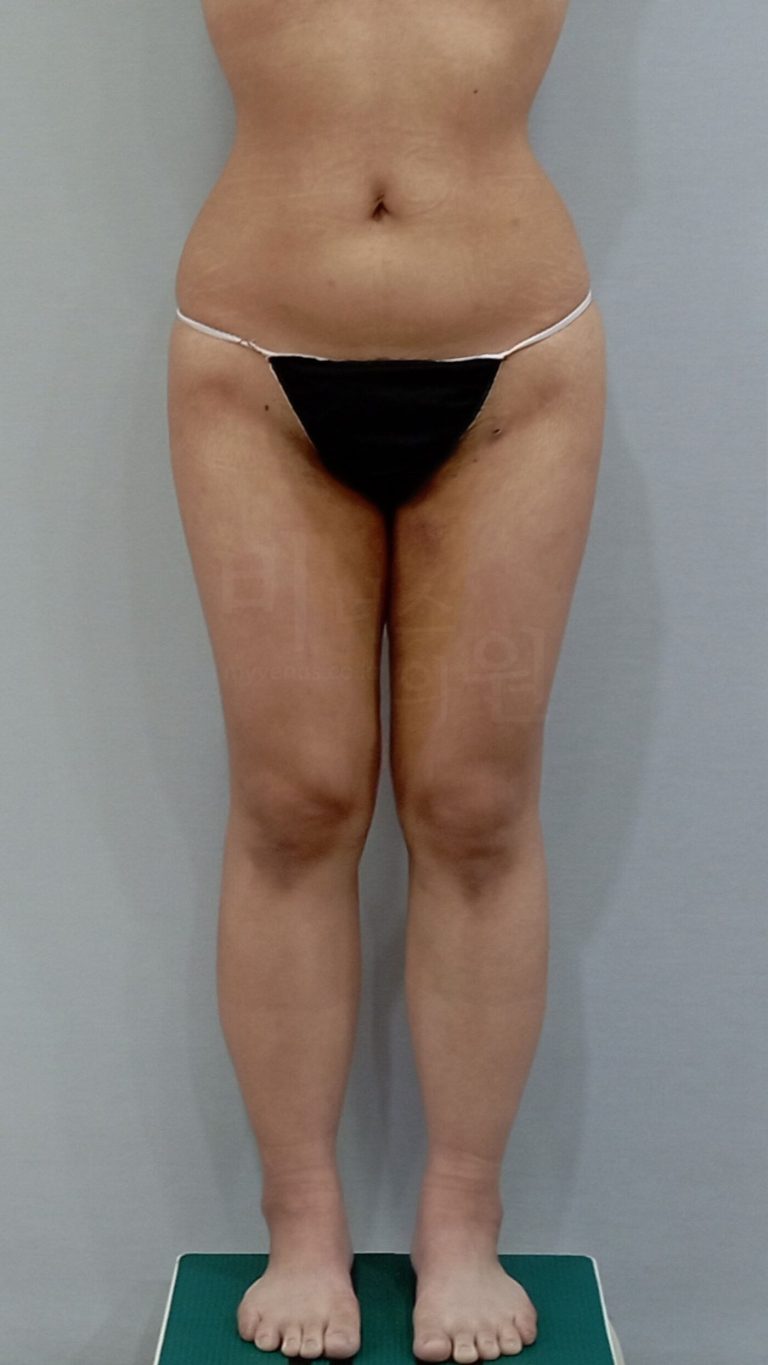 허벅지 지방흡입 회복기, 실제로는 어떻게 흘러갈까 — 수술 후 한 달의 흐름