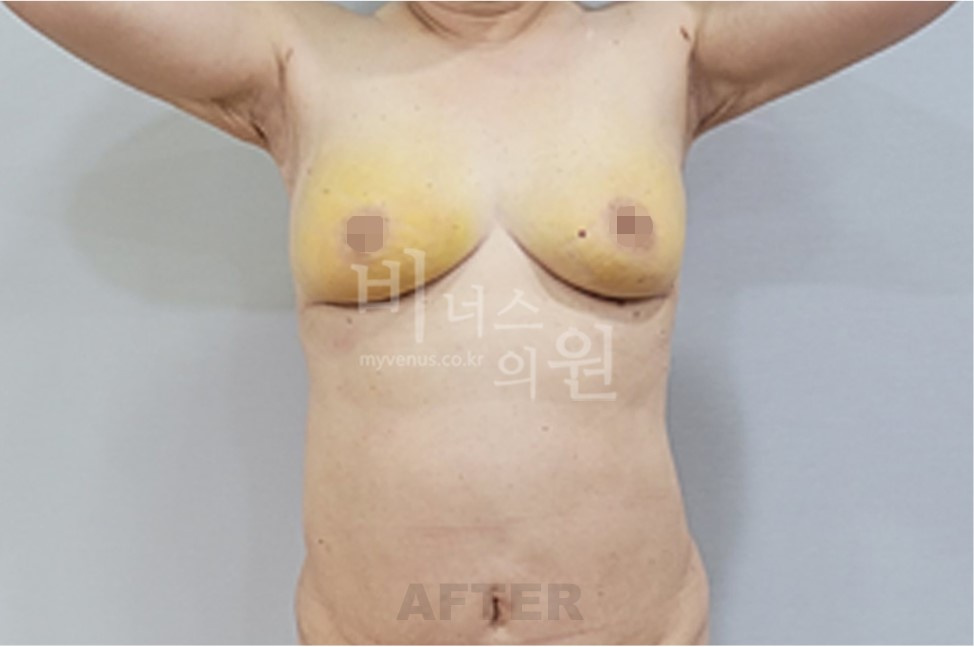 유방하수 지방흡입 전후사진 정면 팔 올린 자세 수술 후