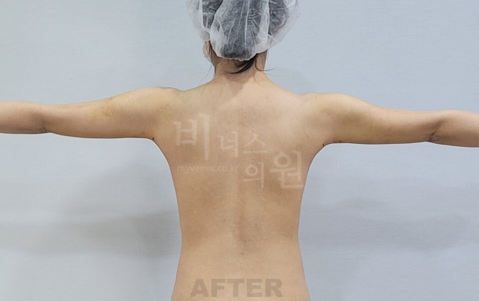 팔뚝지방흡입 수술 후 후면 팔 벌린 자세