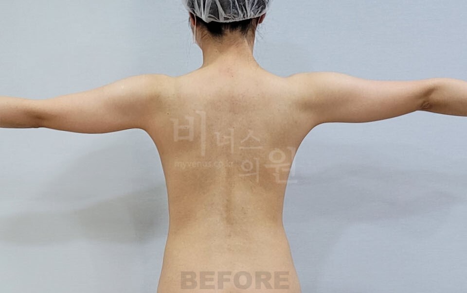 팔뚝지방흡입 수술 전 후면 팔 벌린 자세