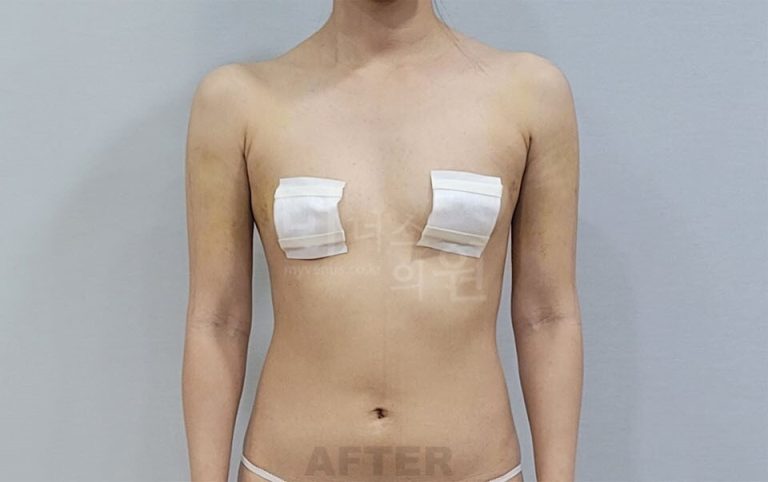 팔뚝지방흡입 수술 후 정면 사진