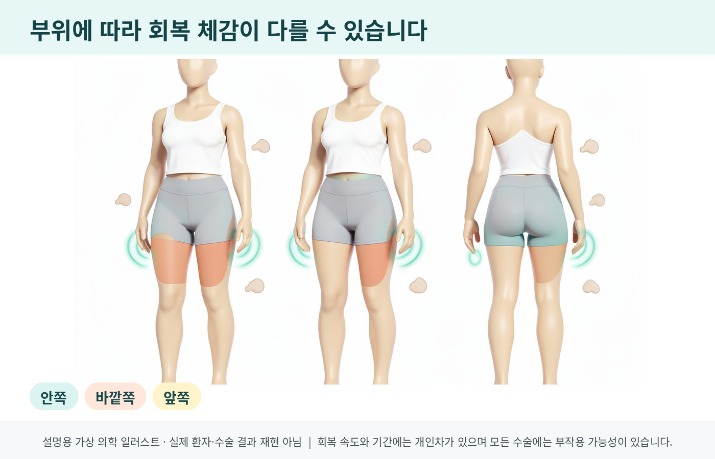 허벅지 안쪽 바깥쪽 앞쪽 부위별 회복 체감 차이 의료 인포그래픽
