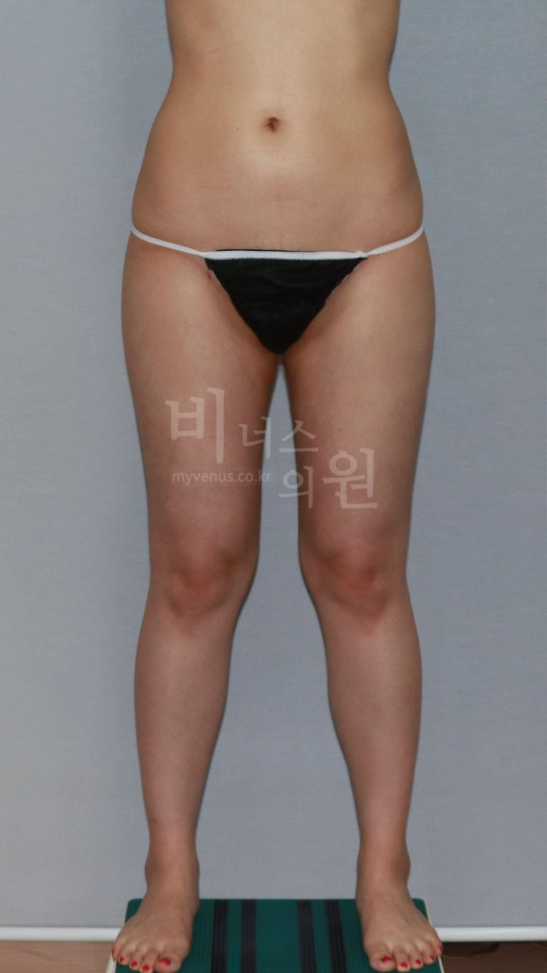 허벅지지방흡입 후 관리, 왜 부위마다 달라야 할까요
