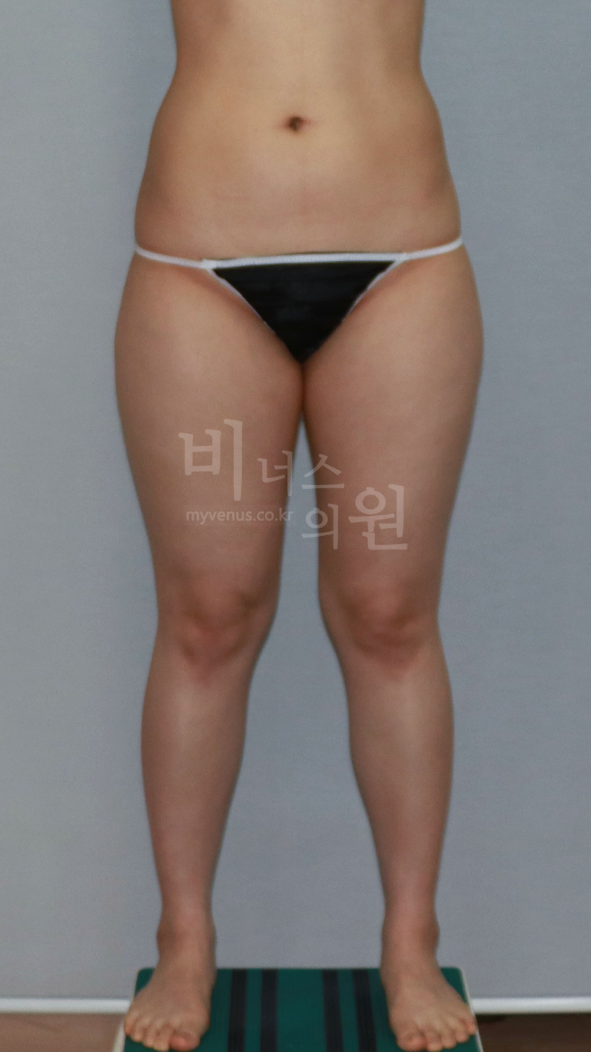 허벅지지방흡입 수술 전 정면 사진