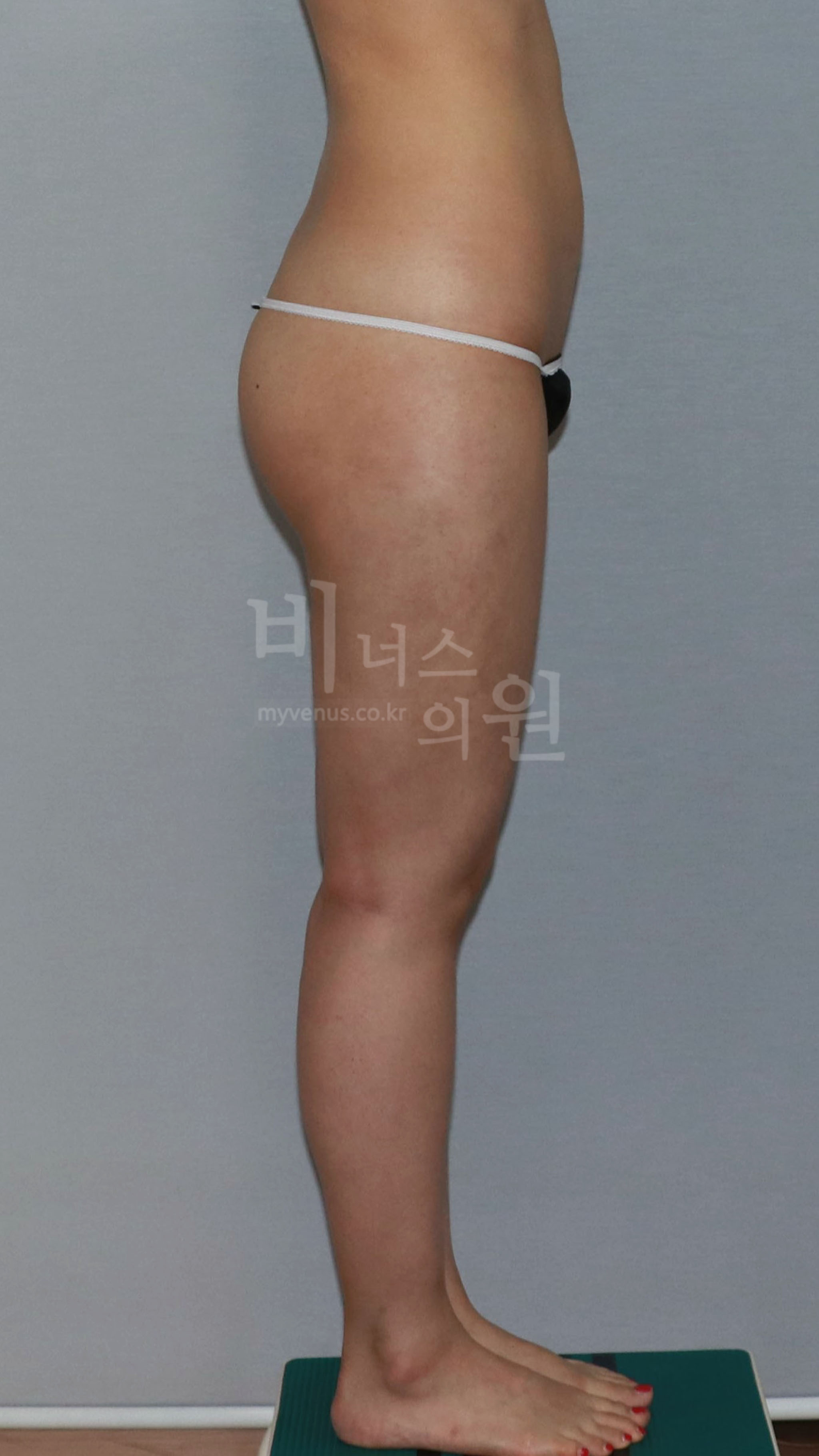 허벅지지방흡입 수술 후 좌측면 사진