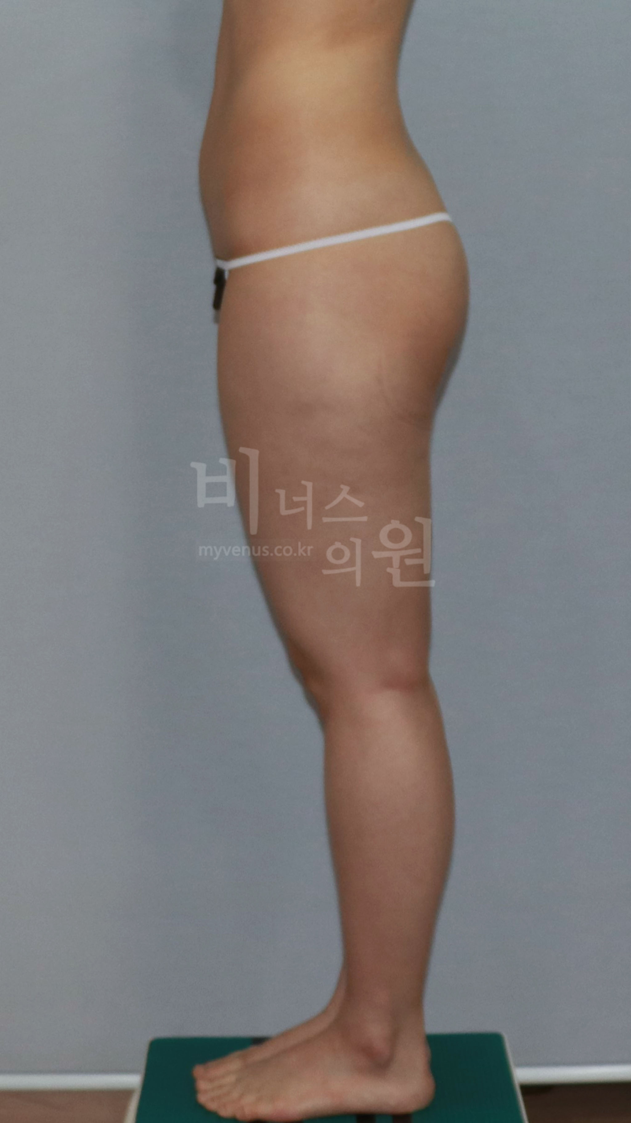 허벅지지방흡입 수술 전 우측면 사진