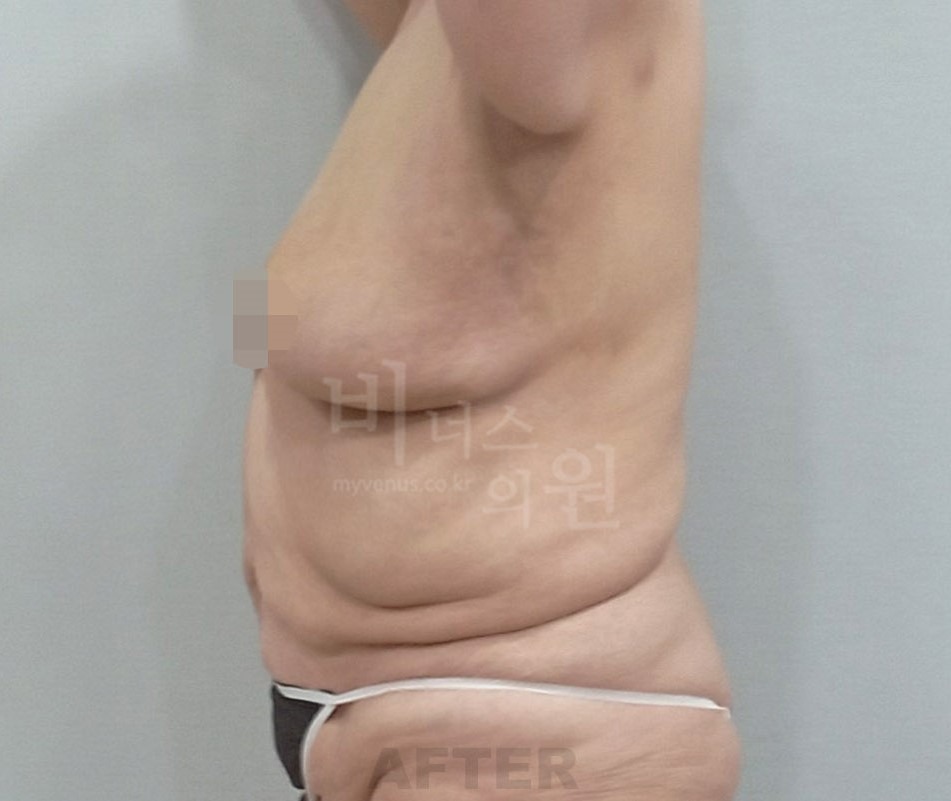 유방하수 지방흡입 수술 후 측면 ① 사진