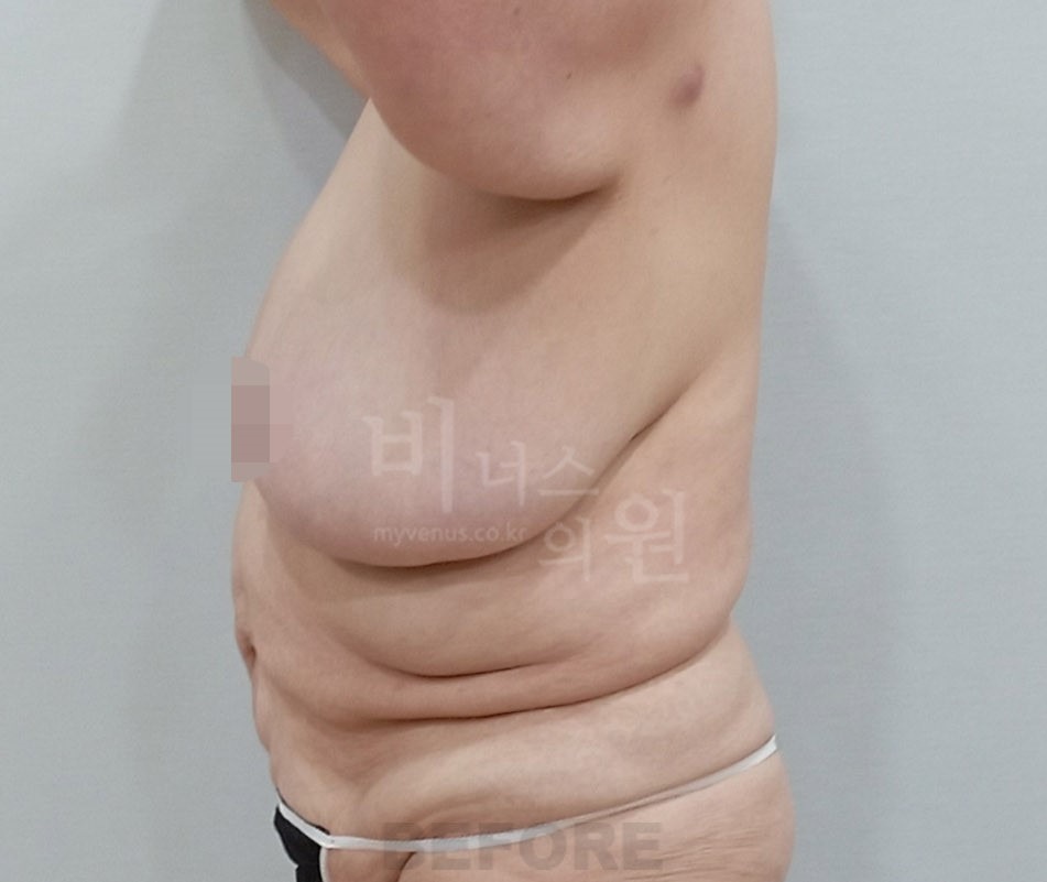 유방하수 지방흡입 수술 전 측면 ① 사진