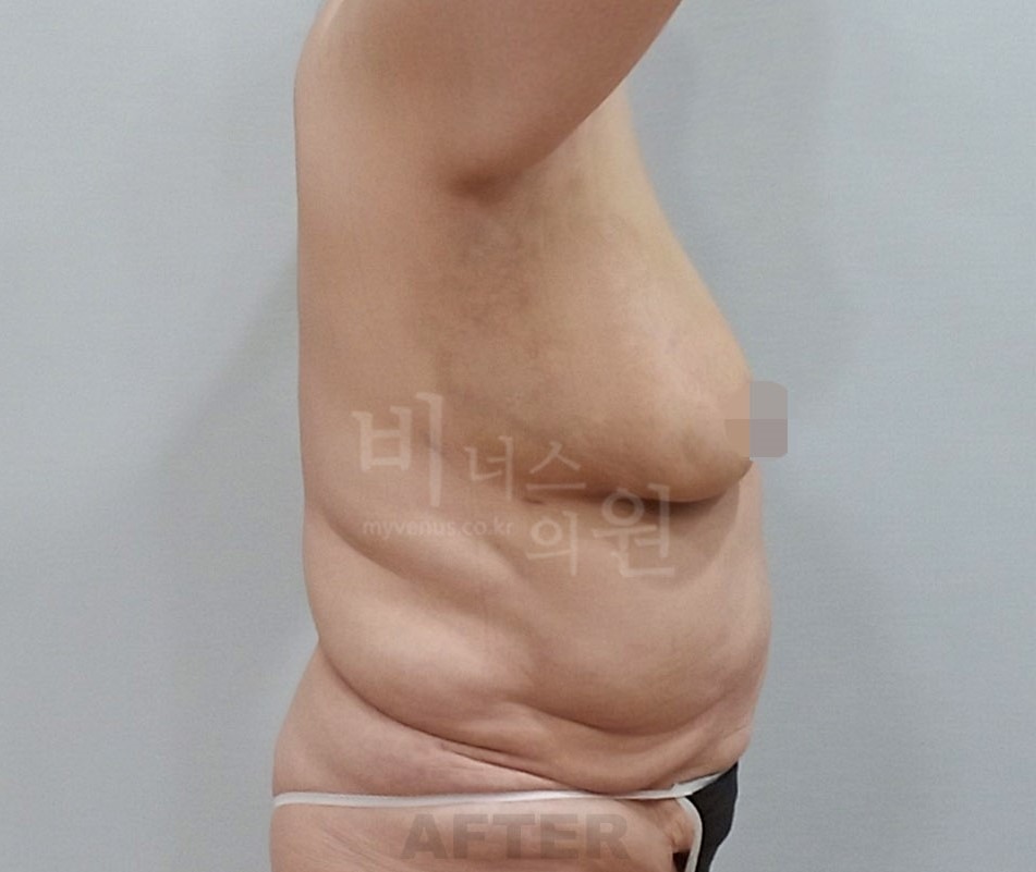 유방하수 지방흡입 수술 후 측면 ② 사진