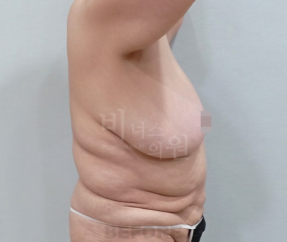 유방하수 지방흡입 수술 전 측면 ② 사진